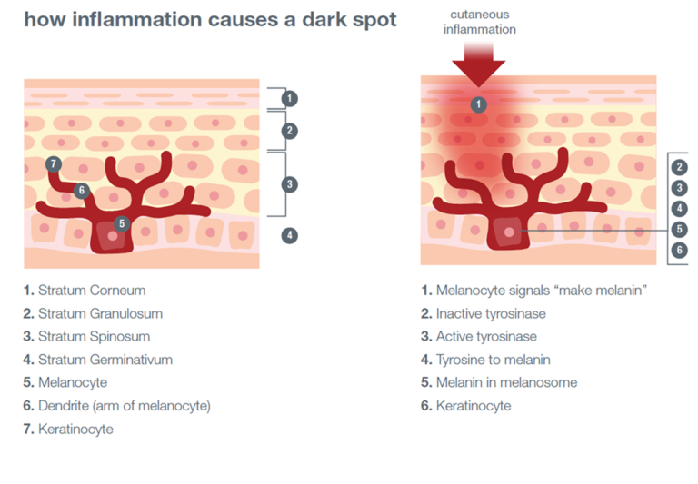 The Science of Dark Spots - International Dermal Instititute